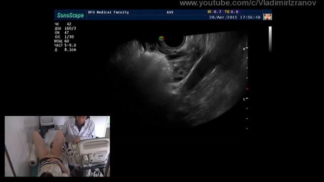 Практическое занятие: УЗИ органов малого таза.  Пациентка 4