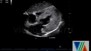 Гипертрофическая кардиомиопатия