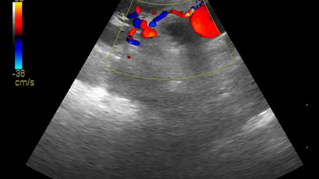 Tumor почки смотреть онлайн