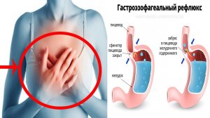 Если у вас ИЗЖОГА, то не ешьте эти ПРОДУКТЫ