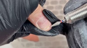 Титановая нить на руках / Коррекционная система на ноготь руки / Травма ногтя / что с ногтем