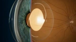 Мультифокальные линзы