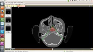 ANGEL 4 - MIA Intercambio de VISORES para imagenes DICOM