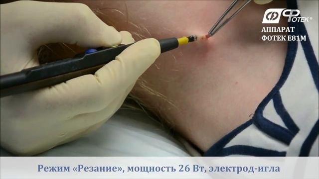 Радиоволновое удаление невуса