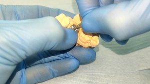 протезирование