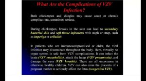 Lecture 13 (3rd course) — Varicella Zoster Virus.mp4