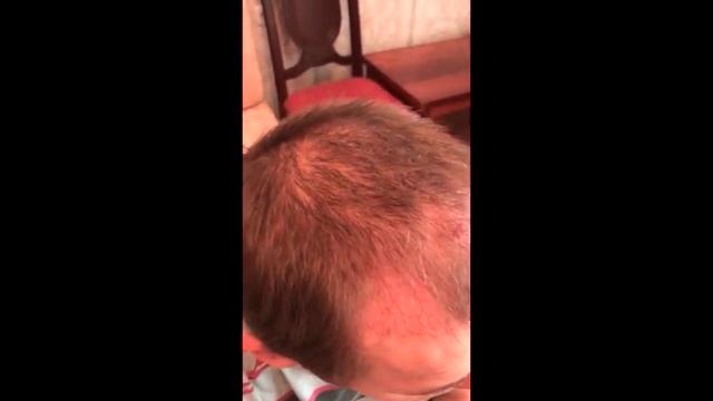 Пересадка волос 3310 графт от А до Я смотреть онлайн