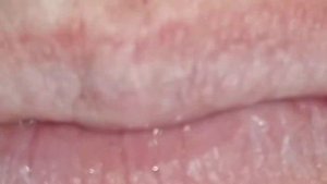 Tonsil stones removal. Granulous tonsil stones. Удаление миндальных камней.