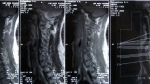 Остеохондроз шейного отдела 2 степени симптомы