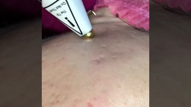 Плазменный душ. Обработка акне. смотреть онлайн