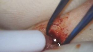 Достаём пулю из щеки , извлекаем пулю от пневматического пистолета , наложение швов