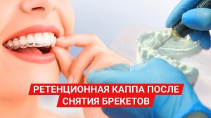 Изготовление капы после снятия брекетов