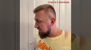 Спустя 5 месяцев после пересадки волос / до и после / цена 1500 евро