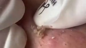 #черныеточки #acne #акне #прыщ #вросшийволос