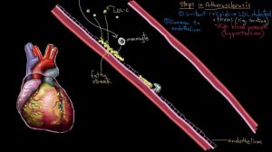 Атеросклероз | Система кровообращения и болезни | NCLEX-RN | Академия Хана
