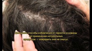 Как избавиться от перхоти в домашних условия: средства, советы, лайфхаки