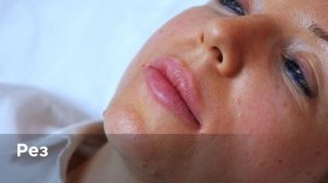 Светлана Кизуб. «Примерка филлера» Коррекция губ Bellarti Lift