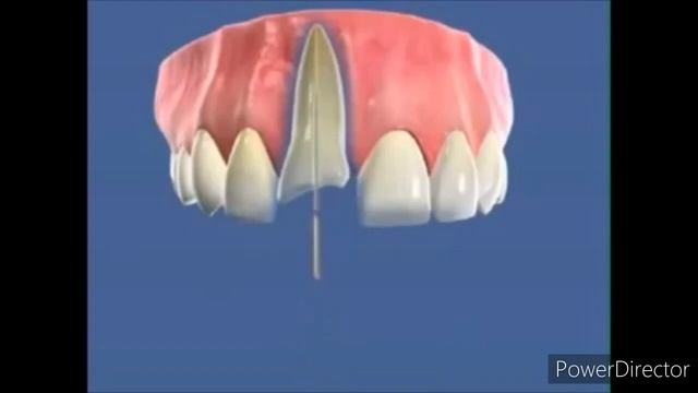 Доктор стоматолог, у меня откололся передний зуб. Что делать? Лечение зуба с помощью штифта и пломб смотреть онлайн