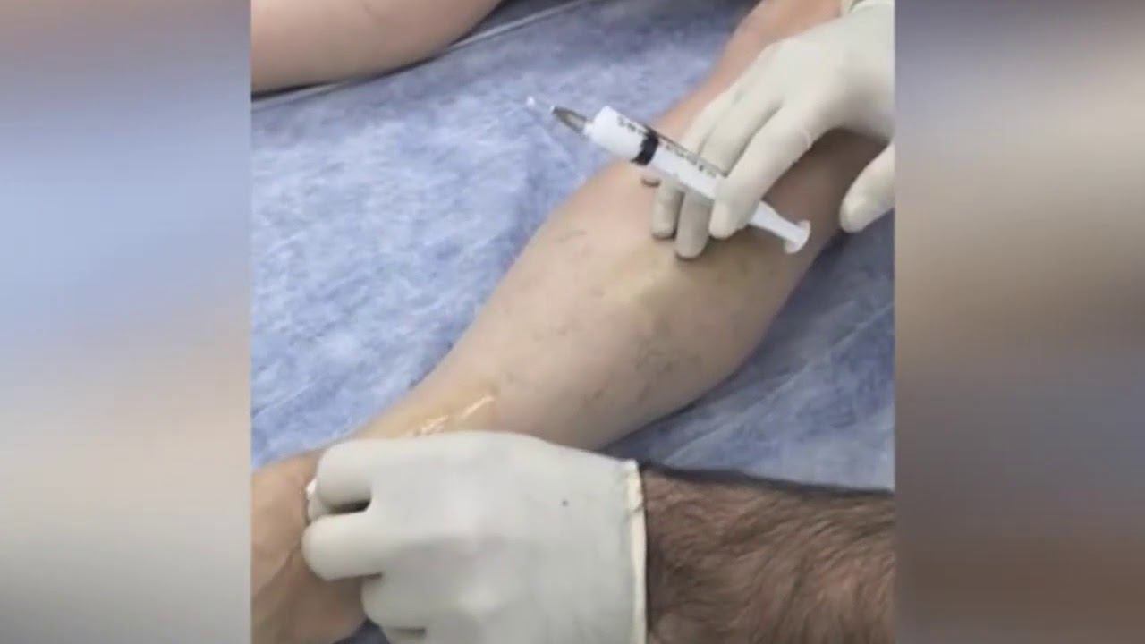 Склеротерапия вен нижних конечностей