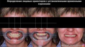 Тотальное протезирование зубов коронками из диоксида циркония