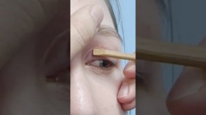 Рубцы после верхней блефаропластики