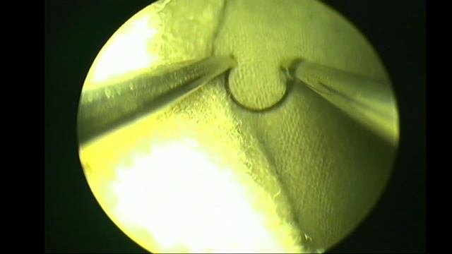 Монополярная трансуретральная резекция аденомы предстательной железы объемом 72см3 смотреть онлайн
