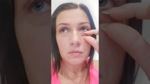 10й день после блефаропластики