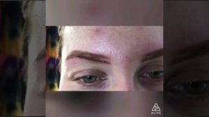 Brows reconstruction. Hidden scar on brow behind microblading. 3d brows