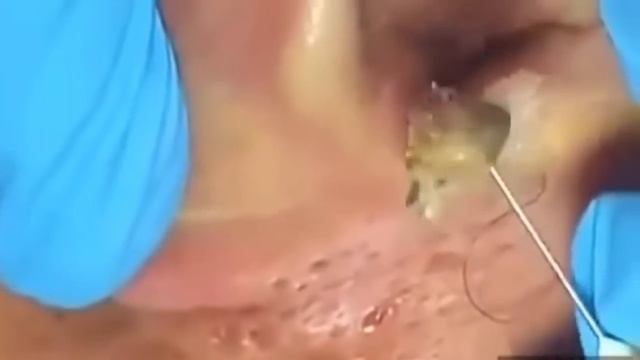 # 5 ШОООК Большая черная точка\КАМЕДОН\Большой жировик\удаление черноголовых смотреть онлайн