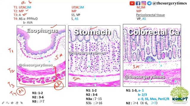 NEXT / EXIT Exam / NEET PG TNM Staging - GIT - AJCC 8th ed смотреть онлайн