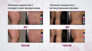 Этоксисклерол