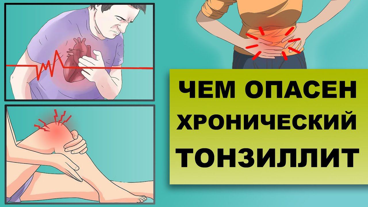ЧЕМ ОПАСЕН ХРОНИЧЕСКИЙ ТОНЗИЛЛИТ