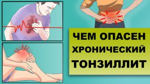 ЧЕМ ОПАСЕН ХРОНИЧЕСКИЙ ТОНЗИЛЛИТ