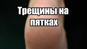 Трещины на пятках. Гиперкератоз. Лечение.