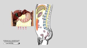 Ход брюшины