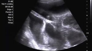 Гидроторакс