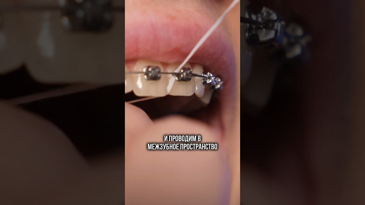 Чистим брекеты зубной нитью ПРАВИЛЬНО. #брекеты #ортодонт #ортодонтическоелечение