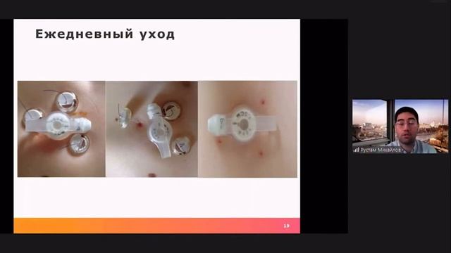 Уход за гастростомой. Михайлов Р. Ш.