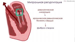 Болезни митрального клапана. Пролапс митрального клапана, стеноз, регургитация.