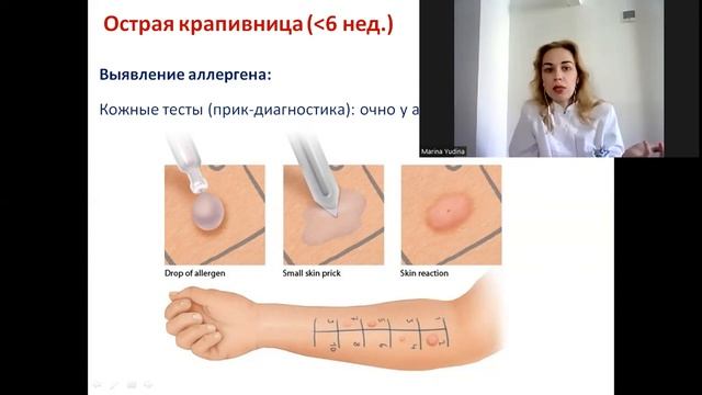 ЧЕК-ЛИСТ АНАЛИЗЫ ПРИ ОСТРОЙ КРАПИВНИЦЕ (длительность менее 6 нед.) смотреть онлайн