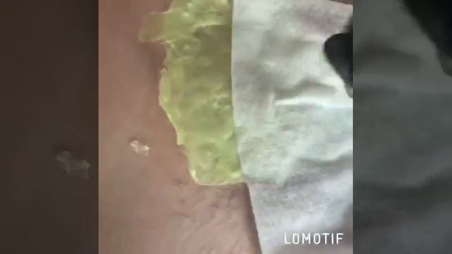 Эпиляция Тула смотреть онлайн