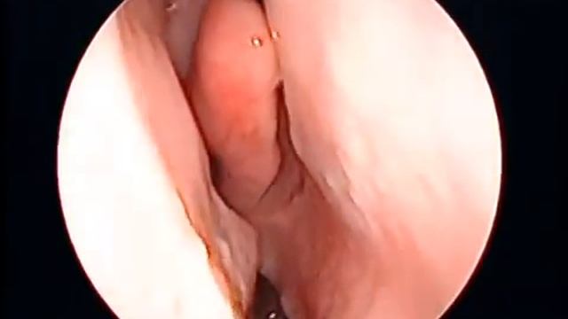 Спайки синехии носа слева  Искривление носовой перегородки.mp4 смотреть онлайн