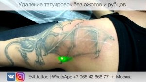 Любую татуировку можно удалить?
