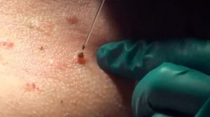 Удаление кожного нароста лазером