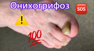 Онихогрифоз⚠️?❗️ • Зачистка✅