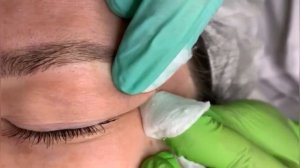 blackhead extraction  | removing cystic acne | чёрные точки | прыщи выдавливание| косметология