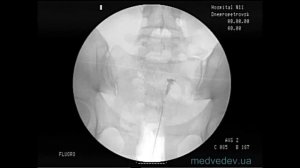 Оценка проходимости маточных труб Медведев