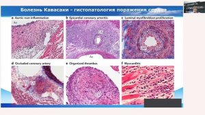 Школа клинического мышления педиатра. Болезнь Кавасаки у детей