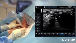 Ultrasound-Guided Continuous Interscalene Brachial Plexus Block - Regional Anesthesia