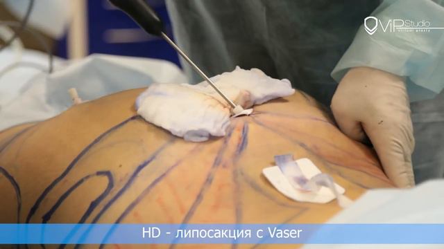 Гурьянов А.С. HD-липосакция и липофиллинг ягодиц.